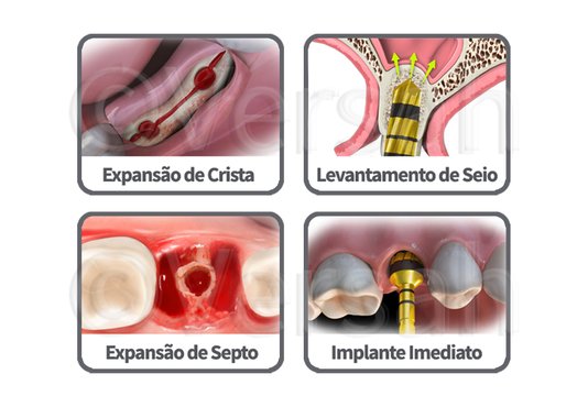Kit Versah de Fresas Densah para Osseodensificação - Fresas Curtas
