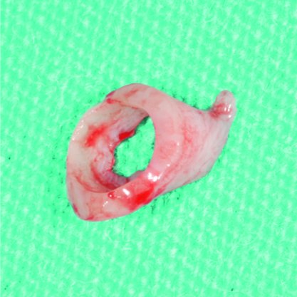 Ring Punch Zepf NIZAM Coletor de Enxerto Queratinizado