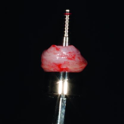Ring Punch Zepf NIZAM Coletor de Enxerto Queratinizado